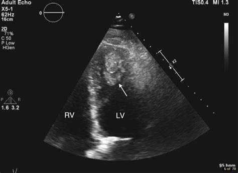 lv mural thrombus treatment guidelines.